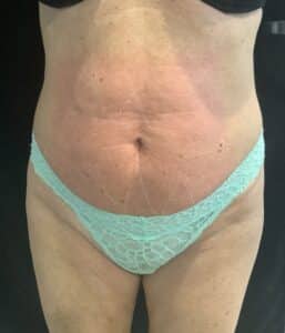 Before Image: TruSculpt – Case 2