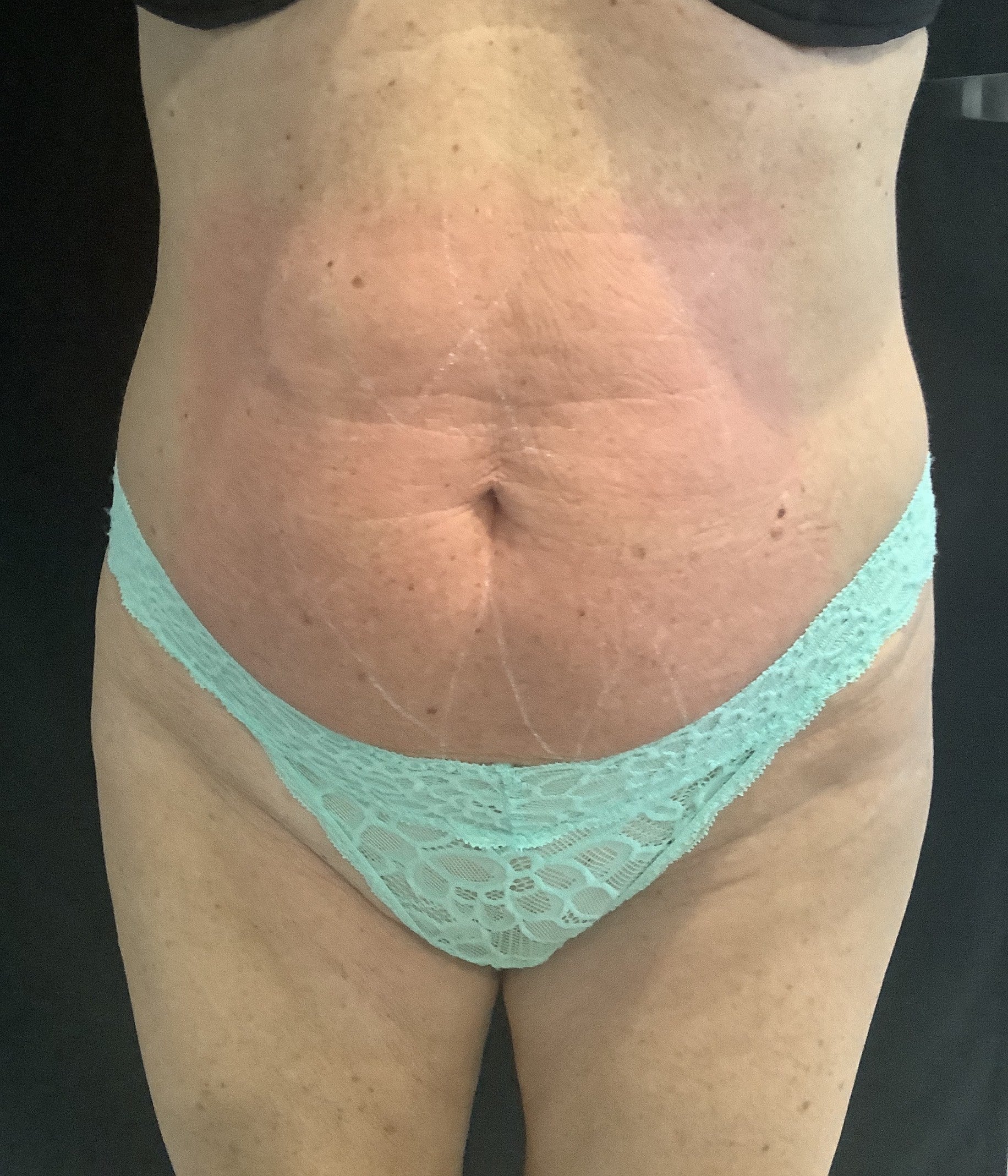Before Image: TruSculpt – Case 2 - front