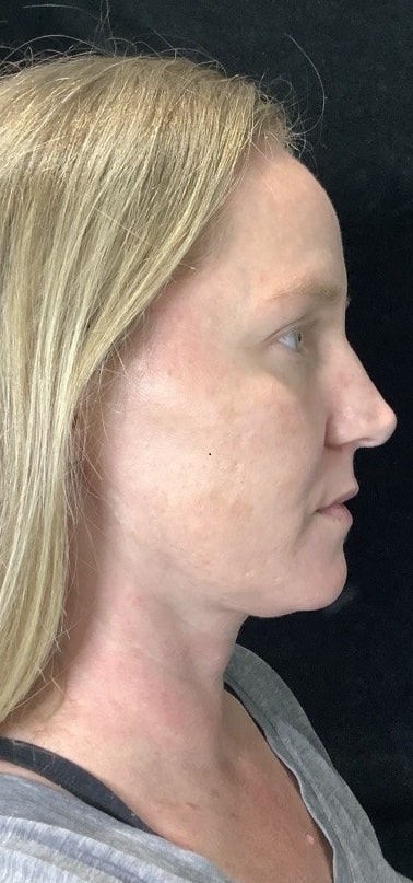 After Image: BroadBand Light (BBL) - right-side