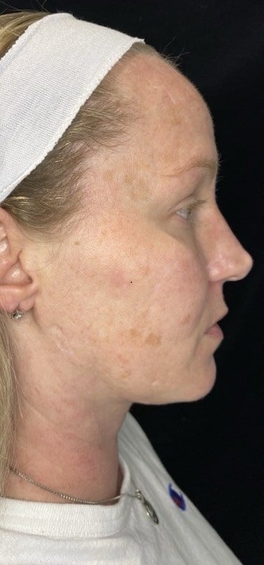 Before Image: BroadBand Light (BBL) - right-side