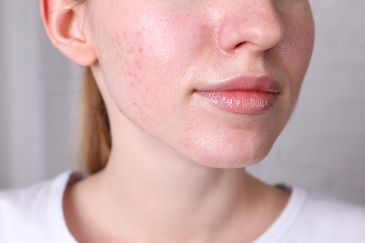 Close-up of a woman with visible acne marks and uneven skin tone and texture on her cheek.