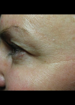 After Image: Botox – Case 1 - other