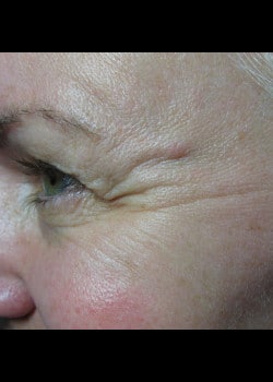 Before Image: Botox – Case 1 - other
