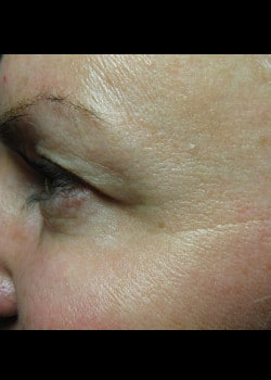 After Image: Crow’s Feet – Case 1 - other