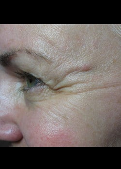 Before Image: Crow’s Feet – Case 1 - other