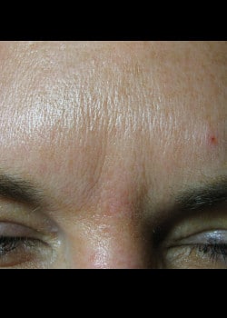 Botox – Case 2