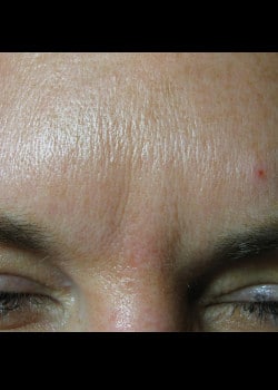 After Image: Frown Lines – Case 1 - other