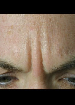 Before Image: Frown Lines – Case 1 - other