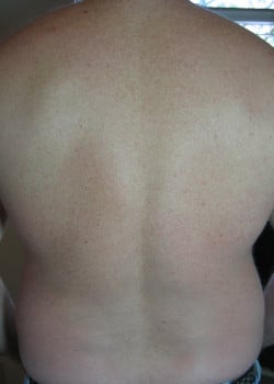 After Image: Laser Hair Removal – Case 1 - back