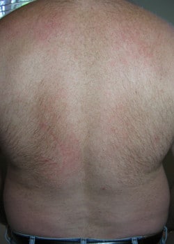 Before Image: Laser Hair Removal – Case 1 - back