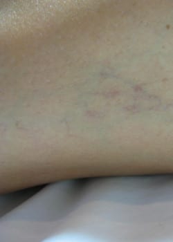 Laser Vein Removal – Case 1