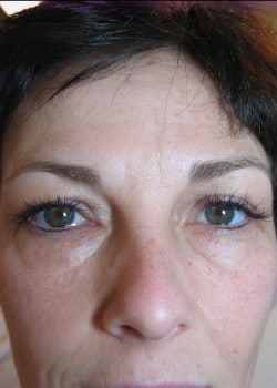 After Image: Permanent Makeup Eyeliner – Case 1 - front