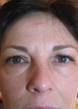 Before Image: Permanent Makeup Eyeliner – Case 1 - front