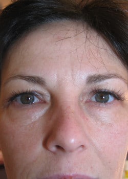 Permanent Makeup Eyeliner – Case 1