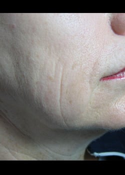 After Image: Restylane – Case 1 - other