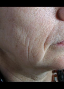 Before Image: Restylane – Case 1 - other