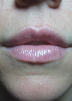 After Image: Restylane – Case 2 - other