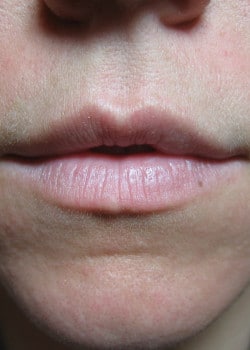 Before Image: Restylane – Case 2 - other