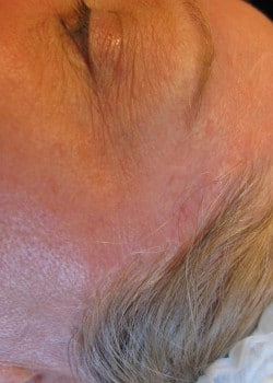 After Image: Scar Repigmentation – Case 1 - other
