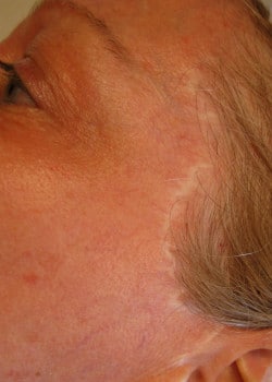 Scar Repigmentation – Case 1