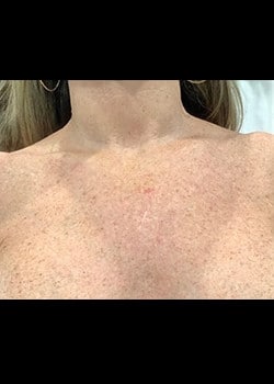 Before Image: IPL Photorejuvenation – Case 1 - front
